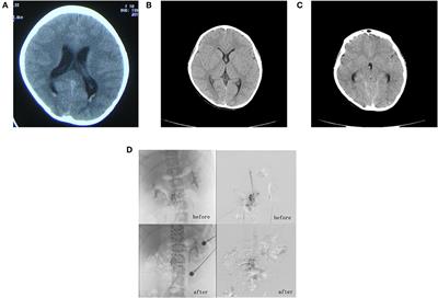 Cobb Syndrome Manifesting as Repetitive Seizures in a 10-Year-Old Girl: A Case Report and Literature Review